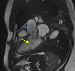 MRI showing the left ventricle (yellow arrow) and the aortic root