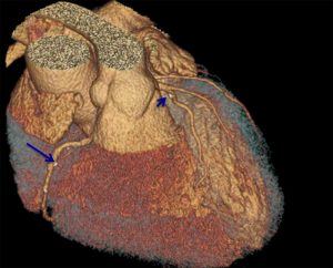 (Example of what a CCTA looks like in a patient with a small amount of plaque buildup in the right coronary artery (arrow) and a left anterior descending artery)