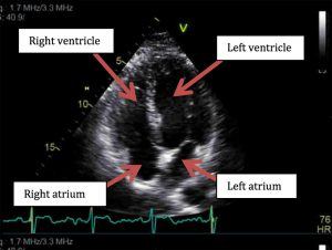 Still Frame Echocardiography