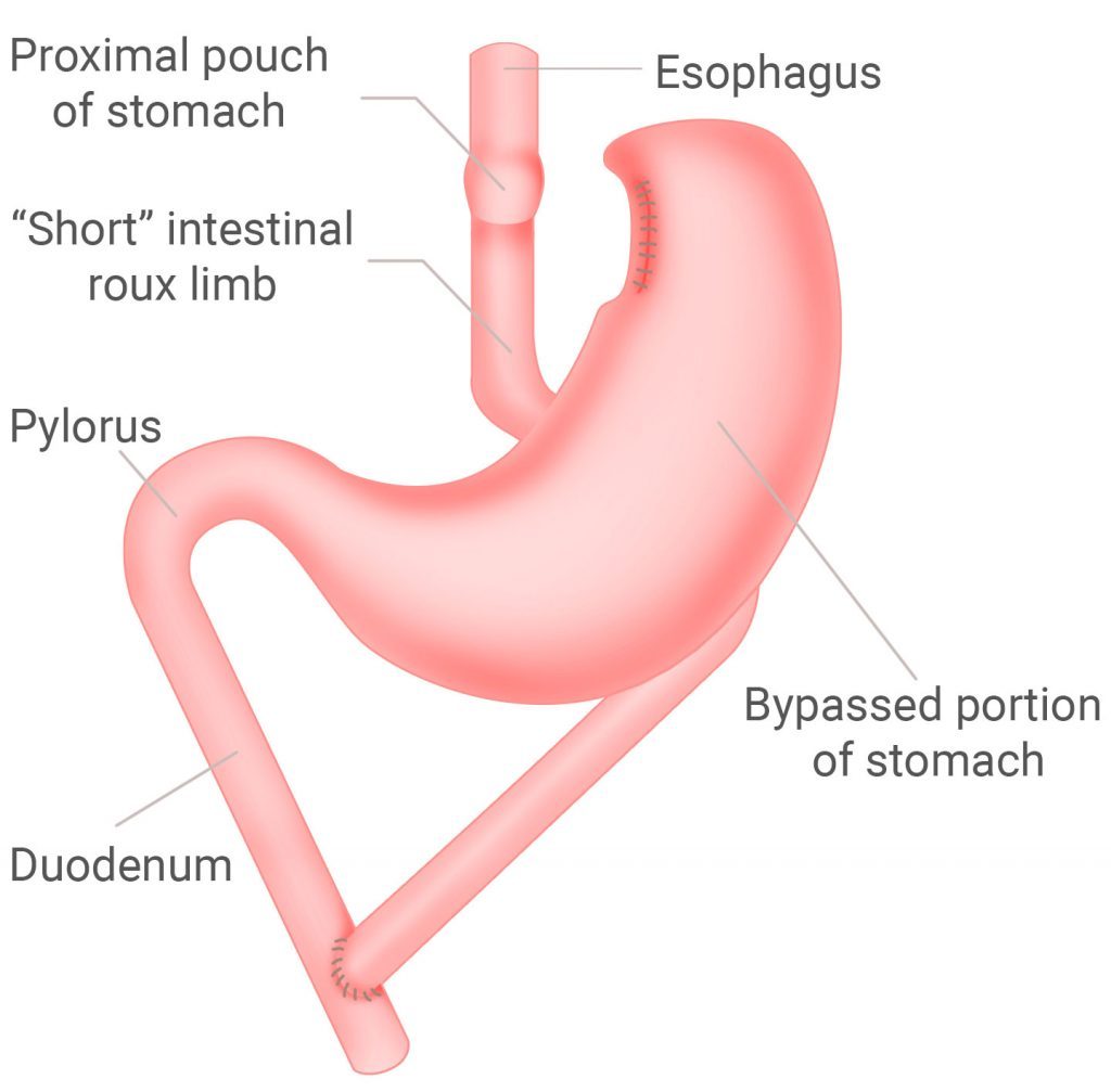 Gastric bypass