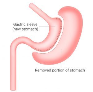 Gastric sleeve